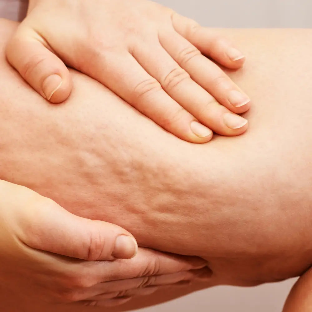 Appelsinhud (Cellulitter)