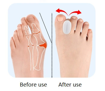 Hallux Valgus tåskiller, 6-pack