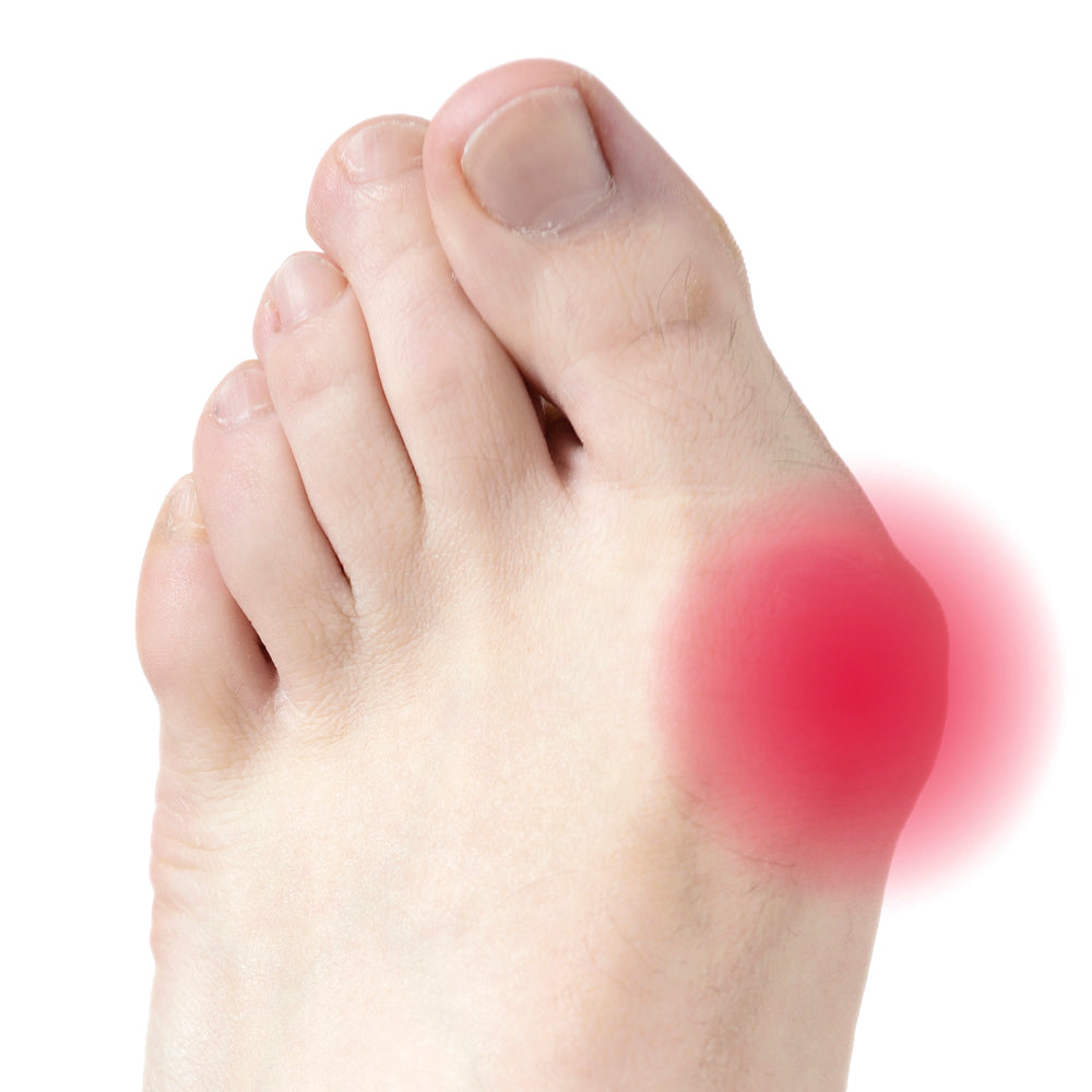Deramed hallux valgus knystbeskytter