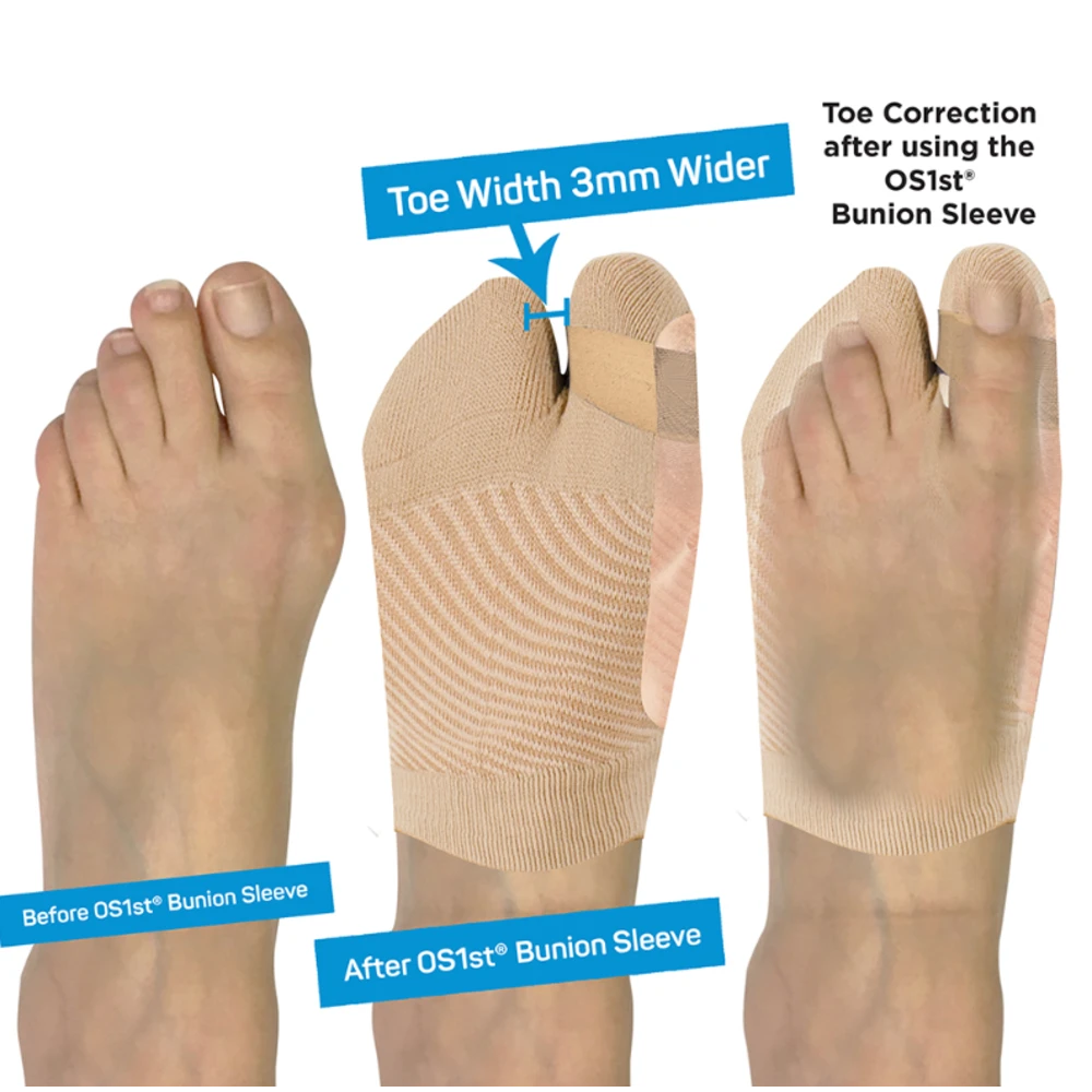 OS1st HV3 Bunion Bracing Sleeve - støttebind til knyster
