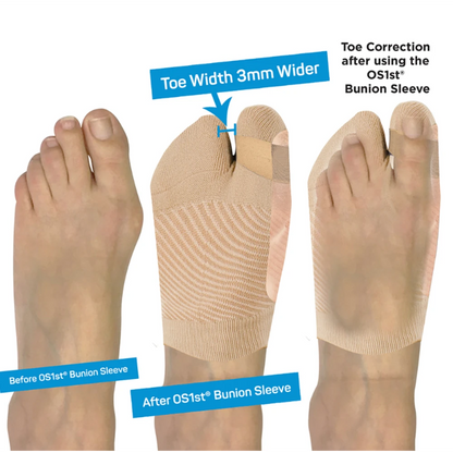 OS1st HV3 Bunion Bracing Sleeve - støttebind til knyster